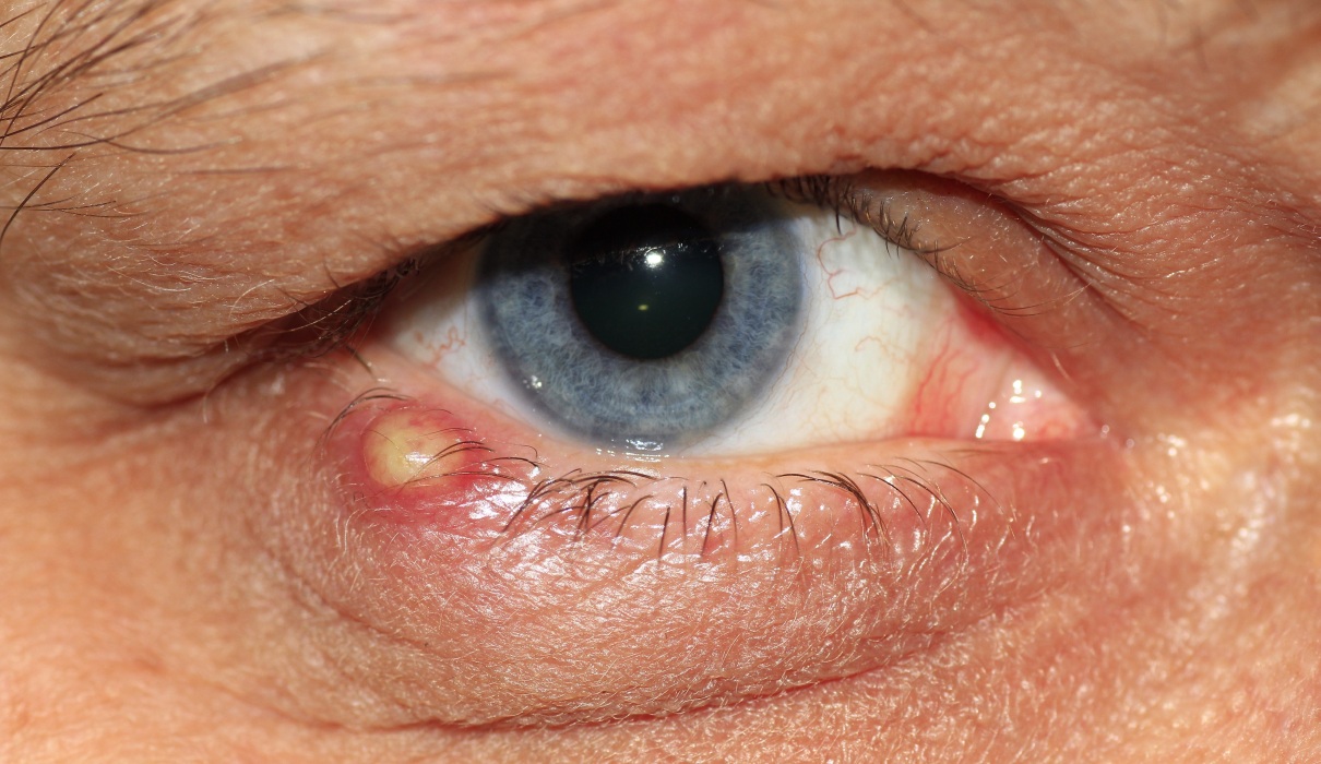 Gerstenkorn - wenn's am Auge schmerzt Gerstenkorn - wenn's am Auge schmerzt