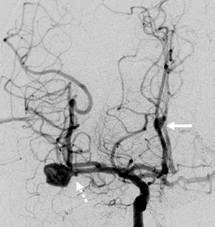 Angiografie zweier Hirnaneurysmen. Deutlich sind die Aussackungen zu erkennen.